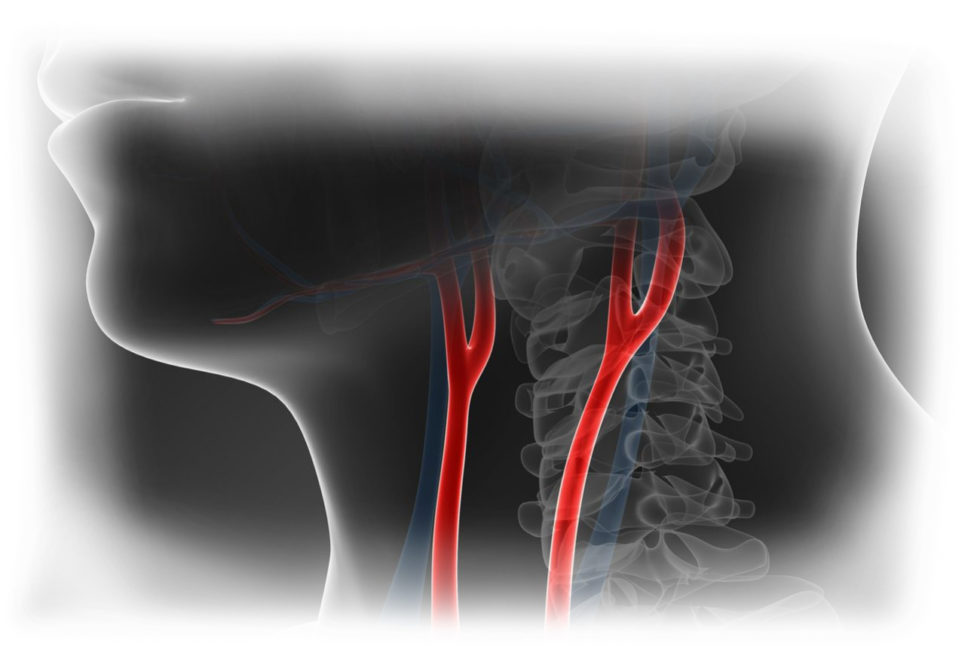 Carotid Artery Evaluation & Treatment | Washington Vascular