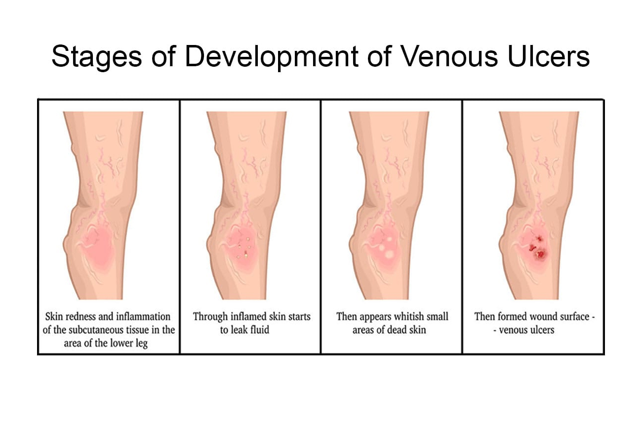 When Is Lower Leg Tingling Related to Vascular Issues? - StrideCare