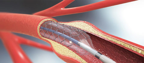 Critical Limb Threatening Ischemia | Washington Vascular