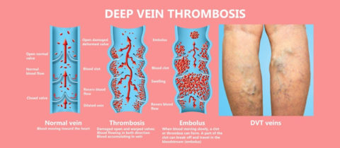 Deep Vein Thrombosis (DVT) | Washington Vascular