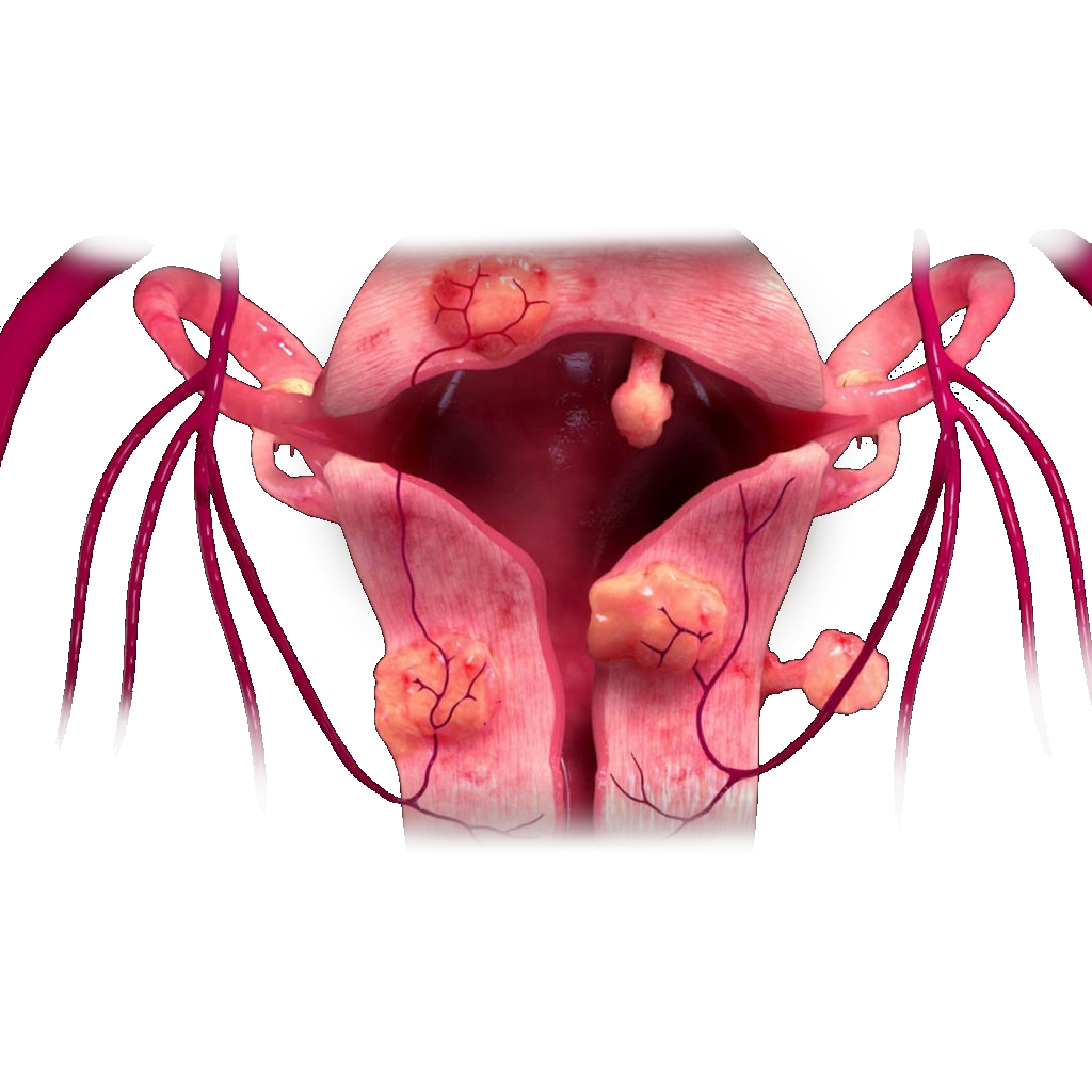 Uterine Fibroid Embolization Washington Vascular 